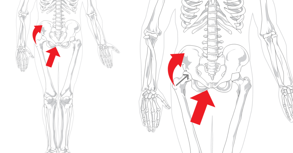 股関節安定化の画像